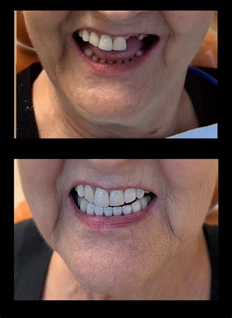 Before And After Full Mouth Reconstruction Avf Dental Group