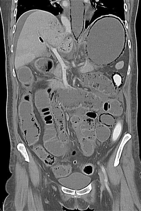 Pneumatosis Intestinalis Of The Entire Gastrointestinal Tract The Bmj