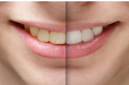 Tooth Discoloration Causes Prevention Ambler Pa Ambler Dental Care