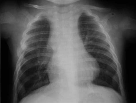 Figure 5 From CONGENITAL LOBAR EMPHYSEMA CLE RADIOLOGIC AND