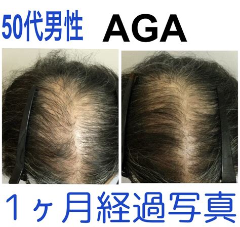 Aga男性型脱毛症 Aga・薄毛治療・発毛ならスーパースカルプ発毛センター川西池田店