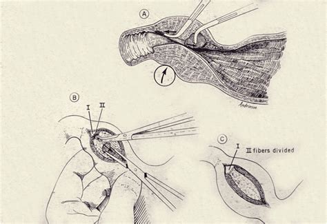 Ramstedt Pyloromyotomy