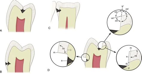 5 Fundamentals Of Tooth Preparation And Pulp Protection Pocket Dentistry