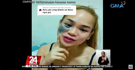 What Causes Birthmarks Kuya Kim Explains Gma News Online