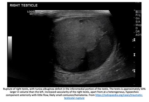 Emdocs Net Emergency Medicine Educationem Am Testicular Rupture