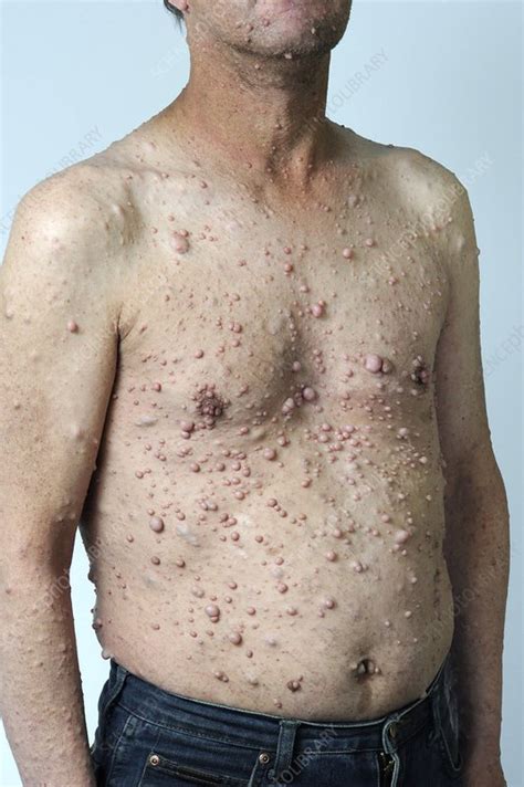Man with neurofibromatosis - Stock Image - C010/3315 - Science Photo ...