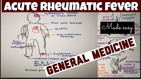 Acute Rheumatic Fever Cardiovascular System General Medicine Neet Series 3rd Year