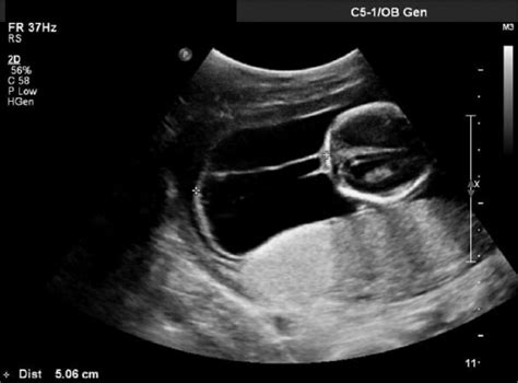 Turners Syndrome Ultrasound