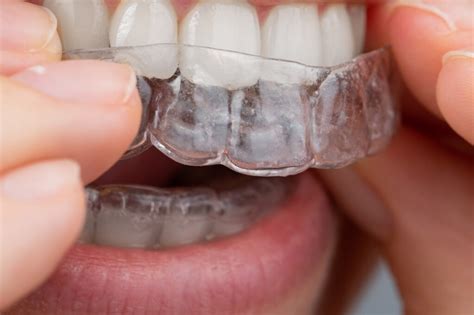 Your Comprehensive Roadmap To The Invisalign Process Narre Warren