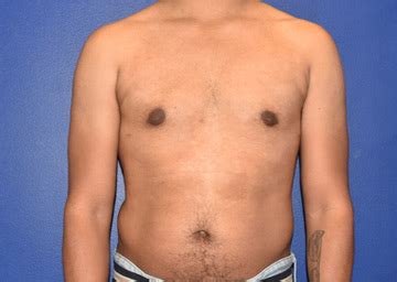 Gallery Gynecomastia Los Angeles Beverly Hills