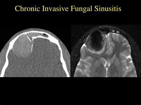 Ppt Fungal Sinusitis An Overview Powerpoint Presentation Free Download Id343185