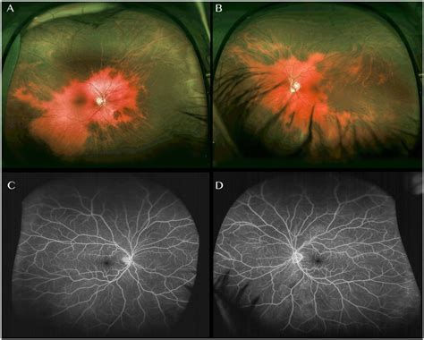 Ultra Wide Field Color Fundus Photograph Of The Right A And Left B