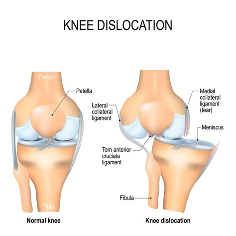 C Tig Fort Roz Knee Dislocation After Slipping Cu Voce Tare A Ezare