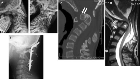 A E Scenario 3 A B Flexion And Extension X Ray Revealing Unstable