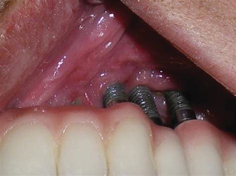 How Dental Hygienists Can Manage Peri Implantitis Patients Registered