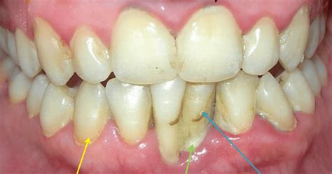 Black Tartar On Teeth A Common Dental Problem Explained Pictures