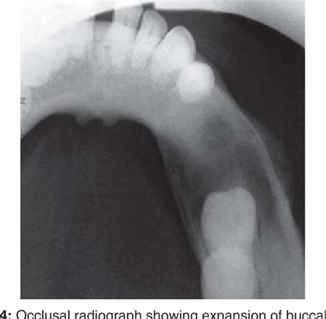 Figure 1 From Management Of Infected Radicular Cyst By Marsupialization Semantic Scholar