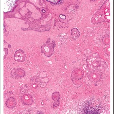 Left Ovarian Cyst Histopathology Aspect In He Coloration Sugestive For