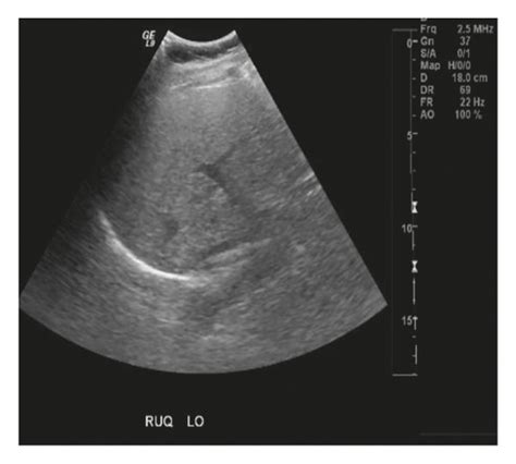 Abdominal Ultrasound Showing Fatty Liver Download Scientific Diagram