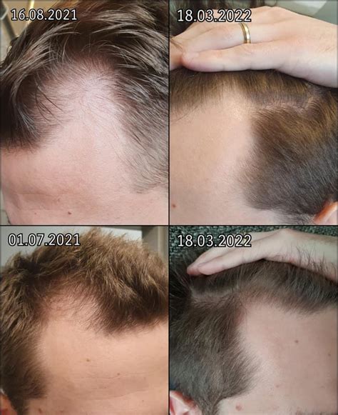 9 Months On Finasteride And 6 Months On Minoxidil R Tressless