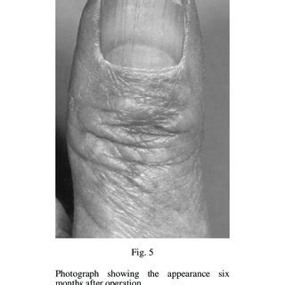 (PDF) The rhomboid flap: A simple technique to cover the skin defect produced by excision of a ...