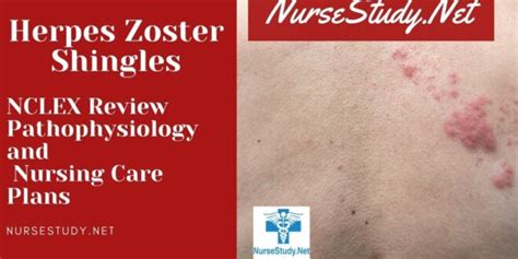 Herpes Zoster Shingles Nursing Care Plans And Diagnosis Interventions