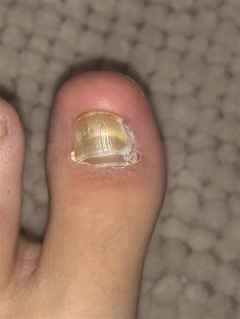 Hard And Thick Toenail 6 Months After Being Removed Why Does It Look