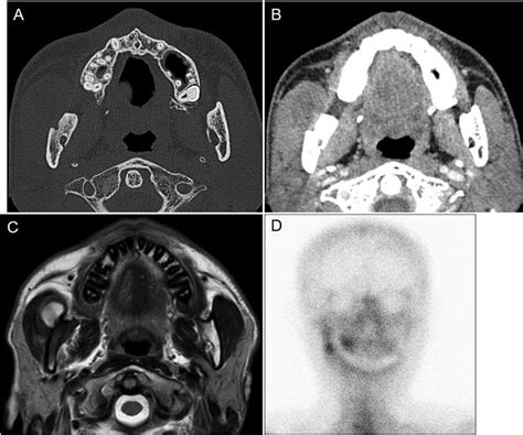 Hypertrophy Of The Masseter Muscles Is Visible On Computed Tomography Download Scientific