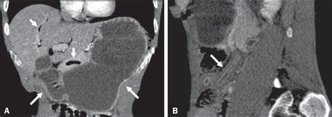 Scielo Brasil Intestinal Strongyloidiasis Radiological Findings