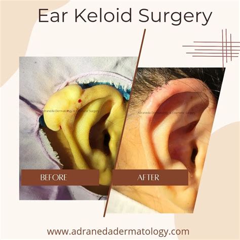 Ear Keloid Surgery – Adraneda Dermatology & Cosmetic Surgery Clinic