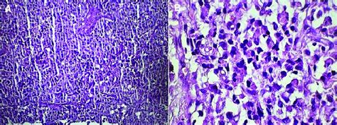 Histopathological Slides Demonstrating A Diffuse Infiltration Of