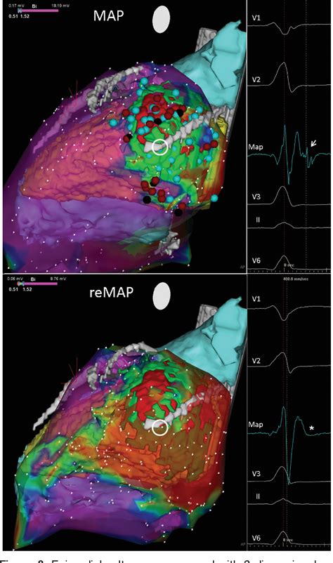 Figure 3 From Improving Safety Of Epicardial Ventricular Tachycardia