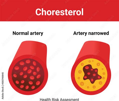 Normal Blood Vessel Versus Artery With Cholesterol Plaque Vector Stock