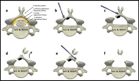 Unilateral Biportal Endoscopic Supralaminar Posterior Spinous Process