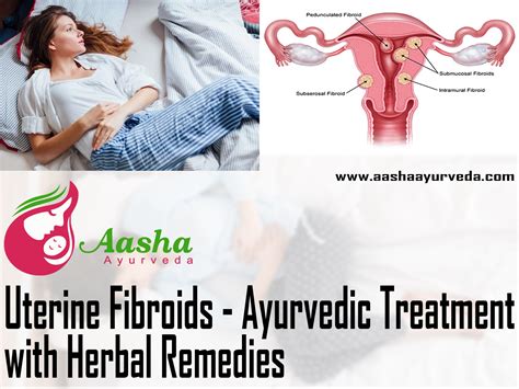 Uterine Fibroids Ayurvedic Treatment With Herbal Remedies Aasha