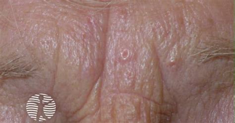 Sebaceous hyperplasia image 