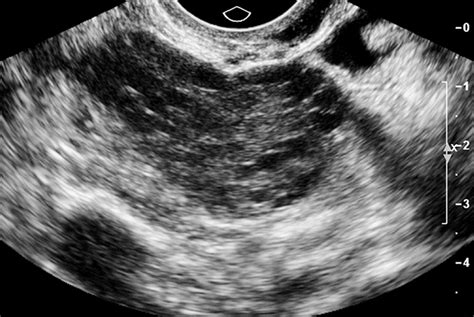 Polycystic Ovarian Syndrome Role Of Imaging In Diagnosis Radiographics