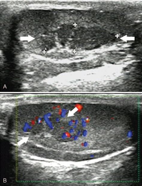 Testicular Adrenal Rest Tumor In A 10 Year Old Patient With Congenital