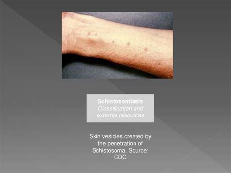 PPT - Schistosomiasis PowerPoint Presentation - ID:2457874