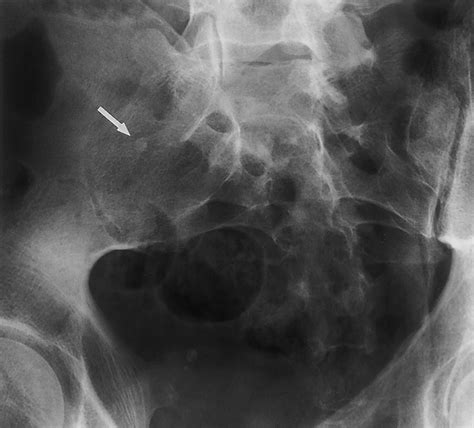 Intravenous Urography Technique And Interpretation Radiographics