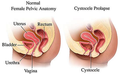 Prolapsed Bladder Causes Symptoms Diagnosis Complication And Treatment