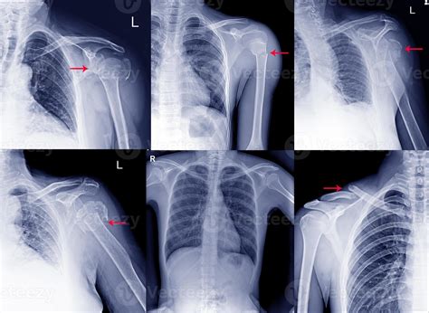 Collection Film X Ray Shoulder Radiograph Show Shoulder Dislocation And Bone Brokenus From