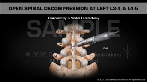 Open Spinal Decompression At Left L3 4 And L4 5 Youtube