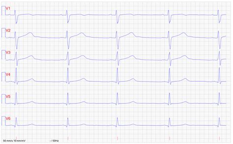 EKG övning test Klinisk diagnostik