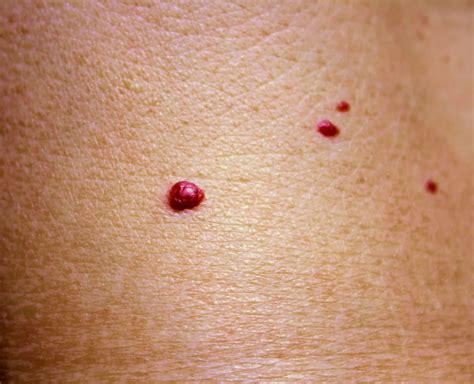 Red Spots On Chest Causes At Cory Whitehead Blog