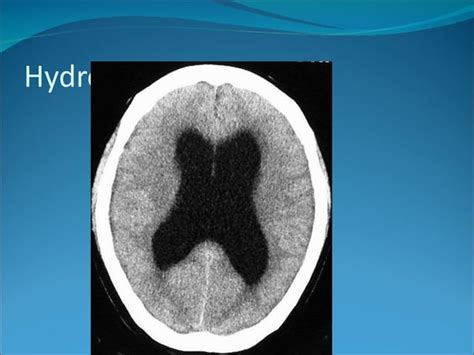 Cerebral Circulation Csf Formation PPT