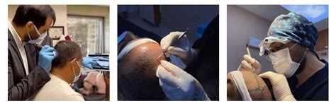 Stem Cell Hair Transplant Hair Restorations Meet A New Future