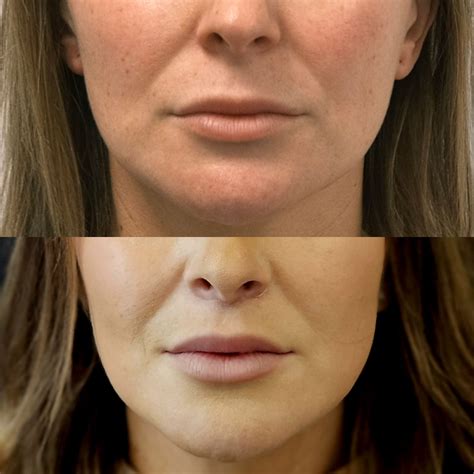 Lip Lift Before And After Gallery