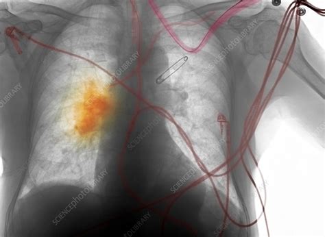 X Ray Smokers Chest Stock Image C0029942 Science Photo Library