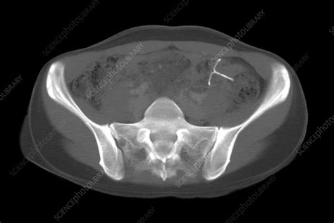 Ectopic Iud Contraceptive Ct Scan Stock Image C002 3290 Science